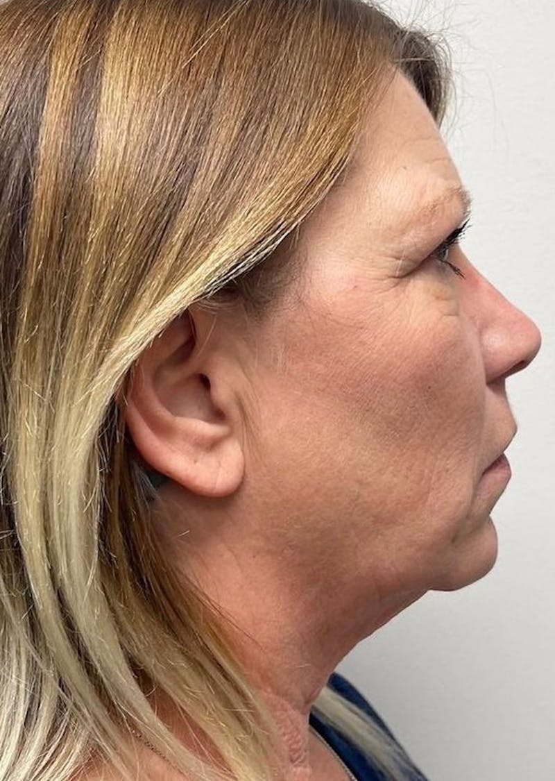 Jawline Contouring Before & After Gallery - Patient 114224 - Image 1