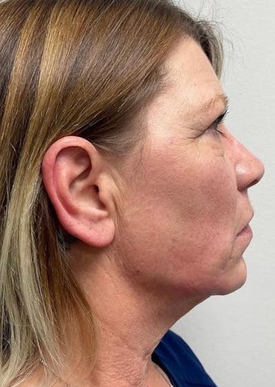 Jawline Contouring Before & After Gallery - Patient 114224 - Image 2