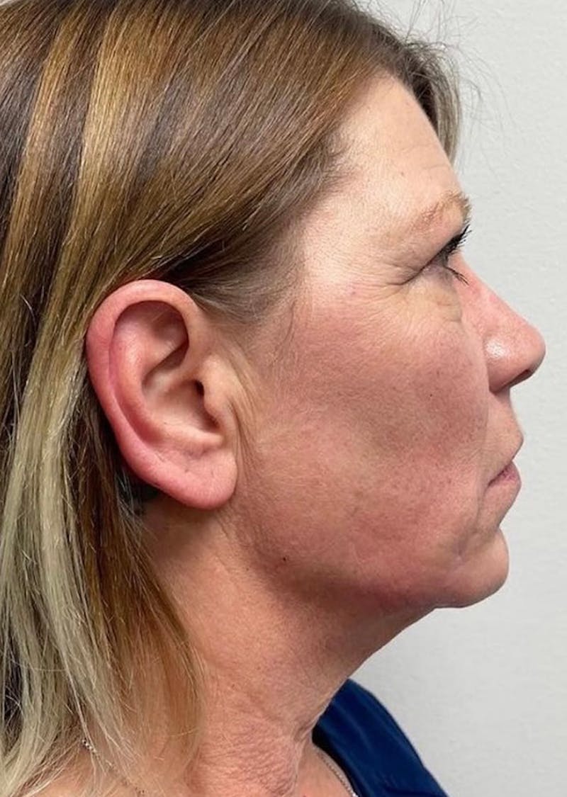 Jawline Contouring Before & After Gallery - Patient 114224 - Image 2