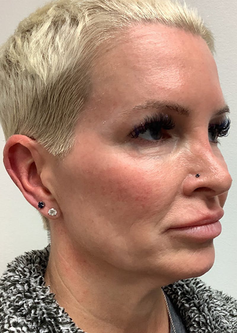 Jawline Contouring Before & After Gallery - Patient 420073 - Image 1