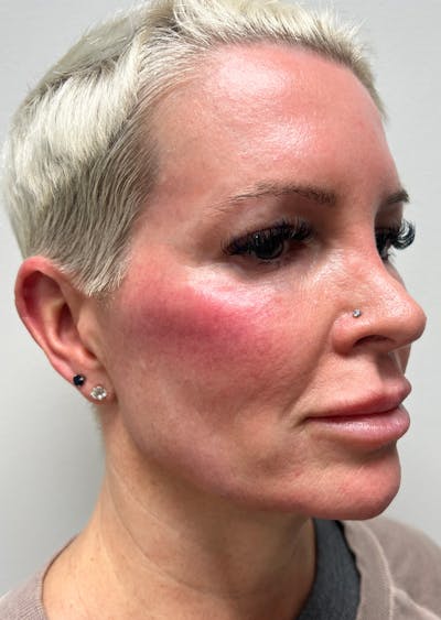 Jawline Contouring Before & After Gallery - Patient 420073 - Image 2