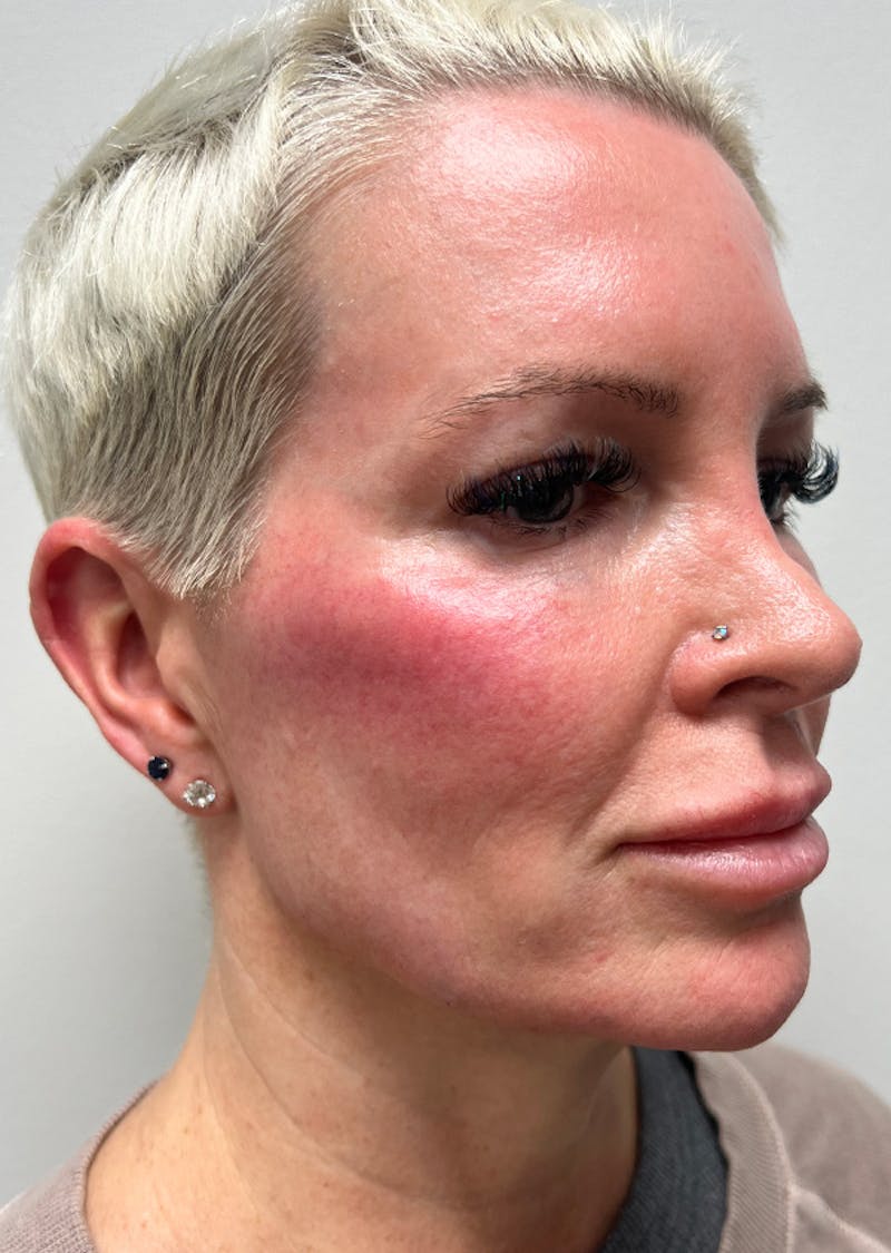 Jawline Contouring Before & After Gallery - Patient 420073 - Image 2