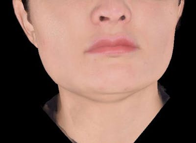 AccuTite Before & After Gallery - Patient 991013 - Image 1