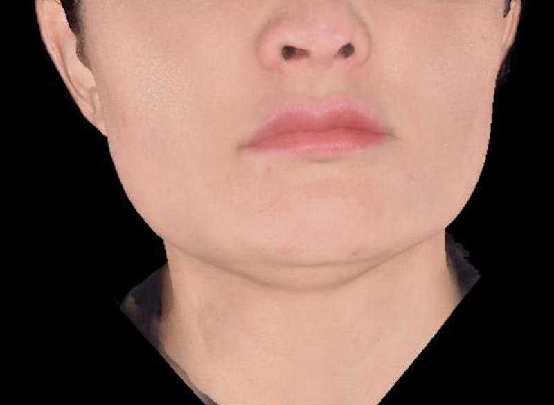 AccuTite Before & After Gallery - Patient 991013 - Image 1