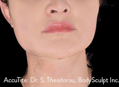 AccuTite Before & After Gallery - Patient 991013 - Image 2