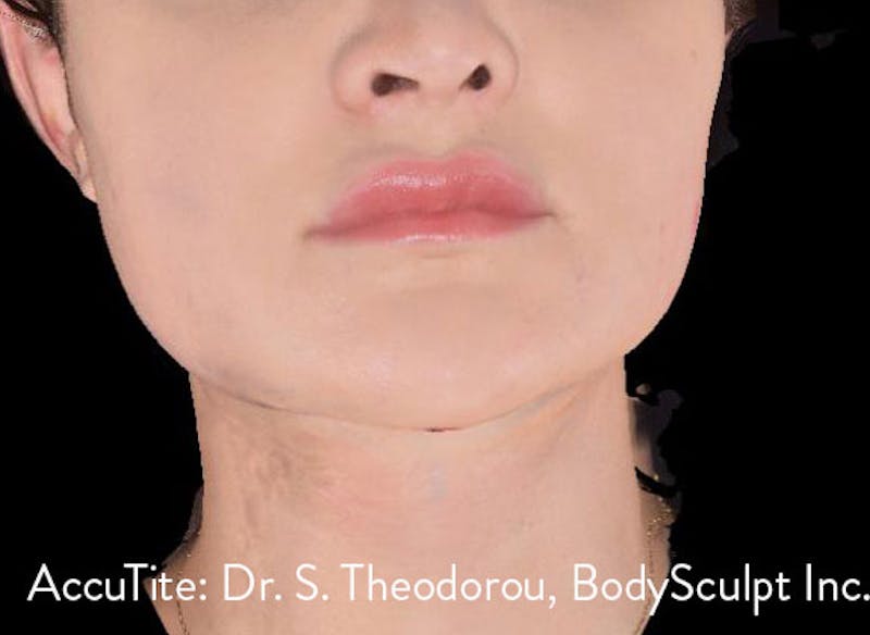 AccuTite Before & After Gallery - Patient 991013 - Image 2