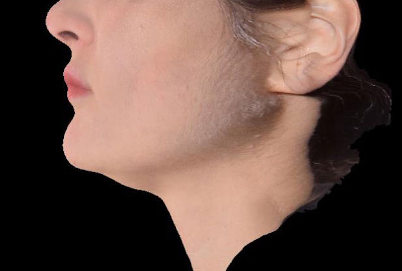 AccuTite Before & After Gallery - Patient 991013 - Image 3