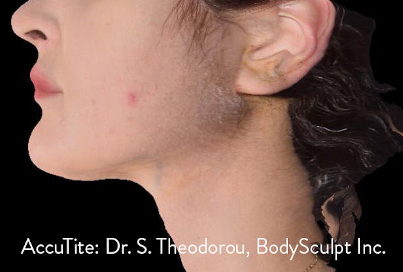 AccuTite Before & After Gallery - Patient 991013 - Image 4