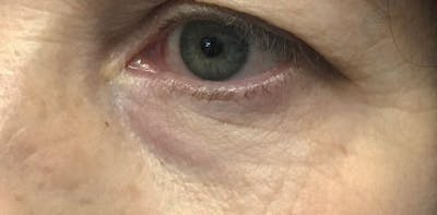 AccuTite Before & After Gallery - Patient 163901 - Image 1