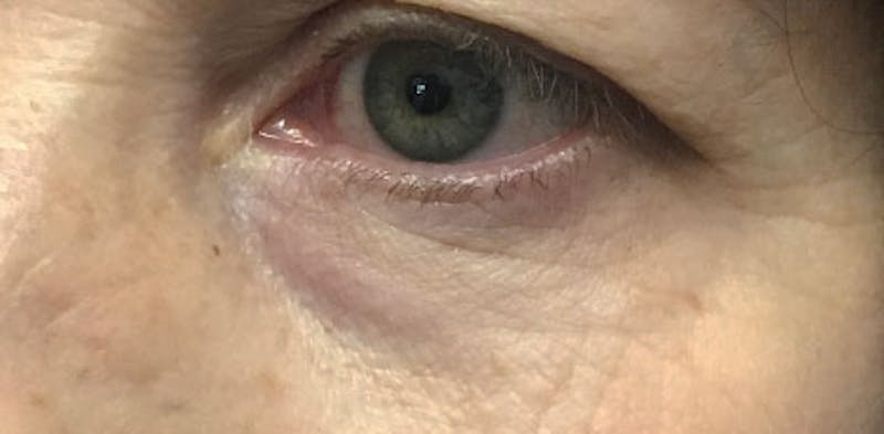 AccuTite Before & After Gallery - Patient 163901 - Image 1