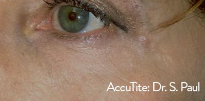 AccuTite Before & After Gallery - Patient 163901 - Image 2