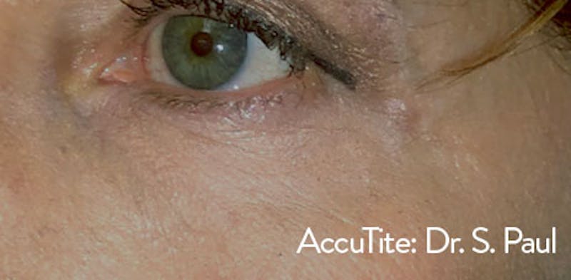 AccuTite Before & After Gallery - Patient 163901 - Image 2