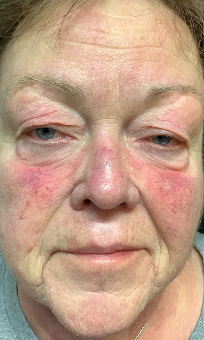 BBL Hero Before & After Gallery - Patient 152217 - Image 1