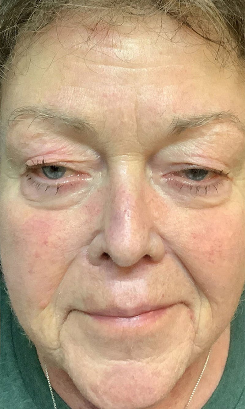 BBL Hero Before & After Gallery - Patient 152217 - Image 2