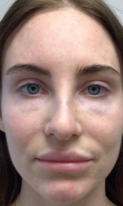 BBL Hero Before & After Gallery - Patient 337308 - Image 1