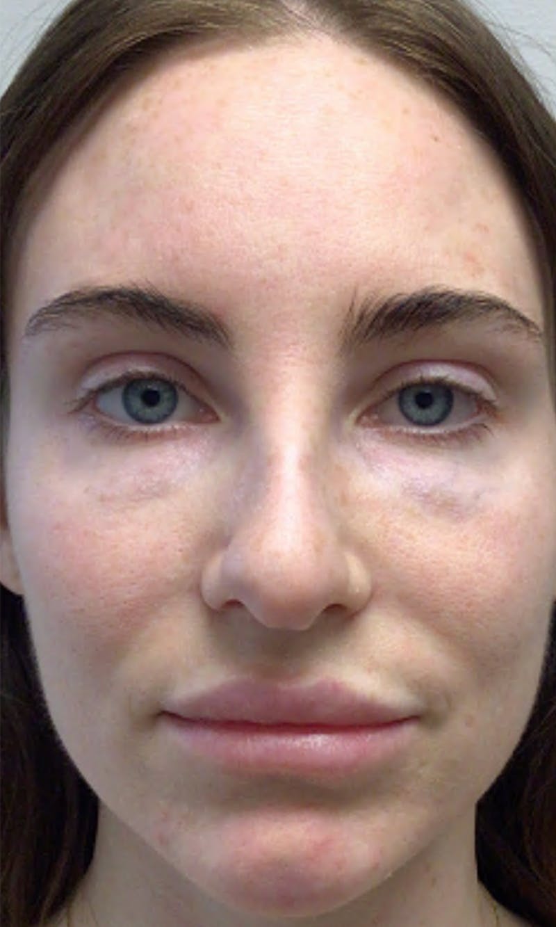 BBL Hero Before & After Gallery - Patient 337308 - Image 1