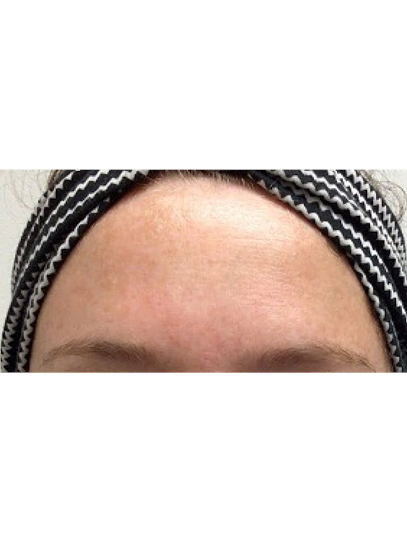BBL Hero Before & After Gallery - Patient 266097 - Image 2