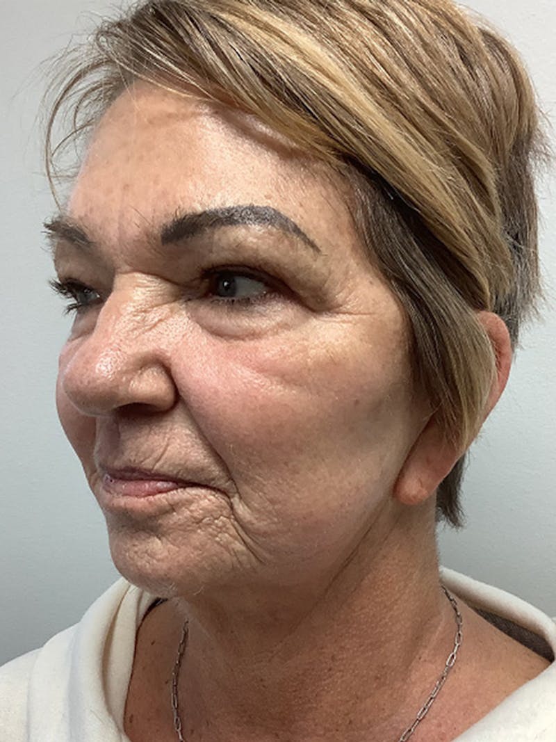 BBL Hero Before & After Gallery - Patient 410167 - Image 2
