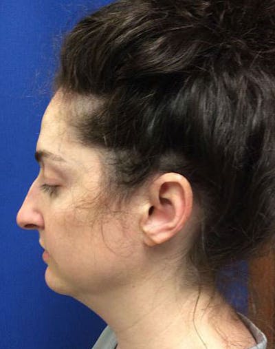 Evoke Before & After Gallery - Patient 414506 - Image 1