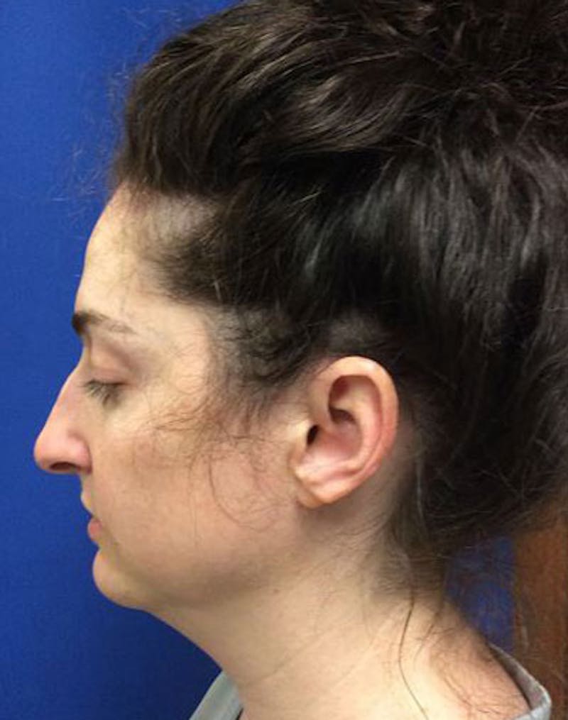 Evoke Before & After Gallery - Patient 414506 - Image 1