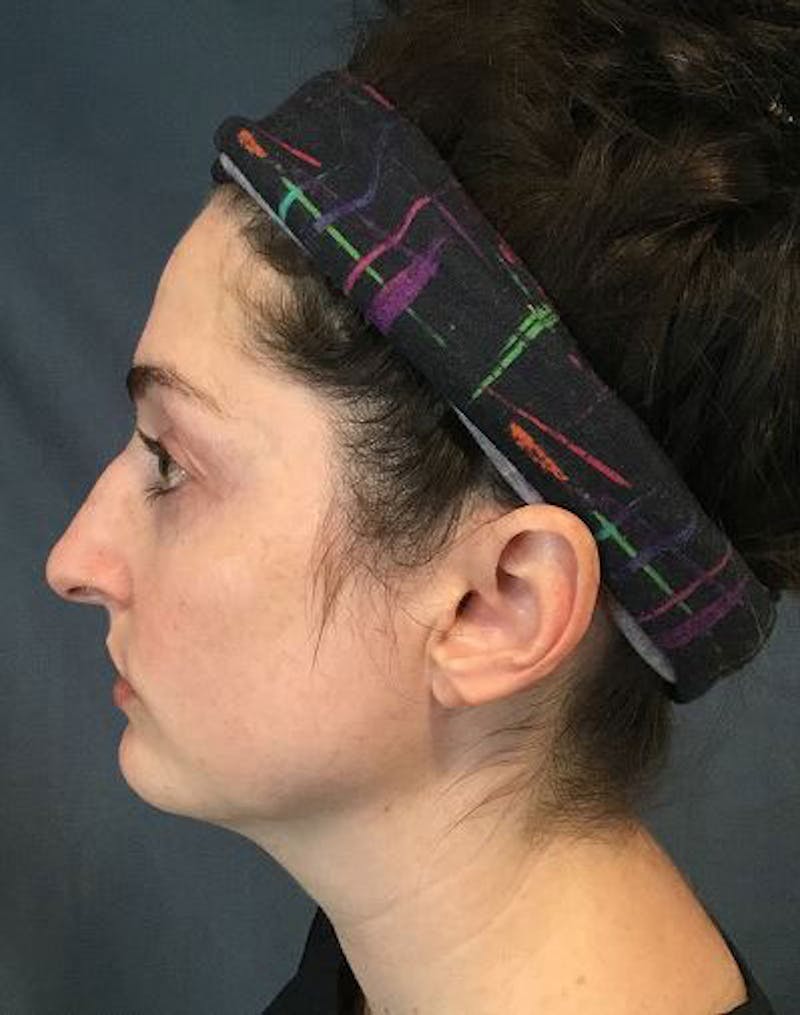 Evoke Before & After Gallery - Patient 414506 - Image 2