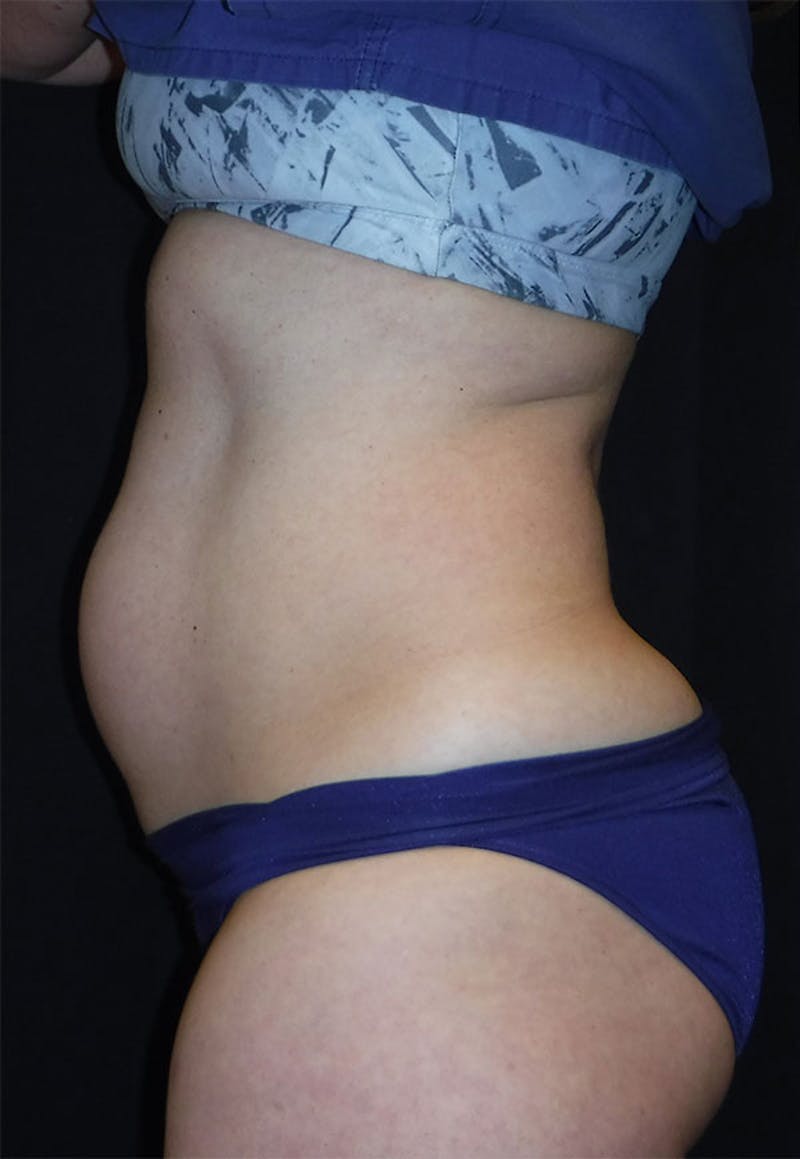 Evolve by InMode Before & After Gallery - Patient 347805 - Image 1
