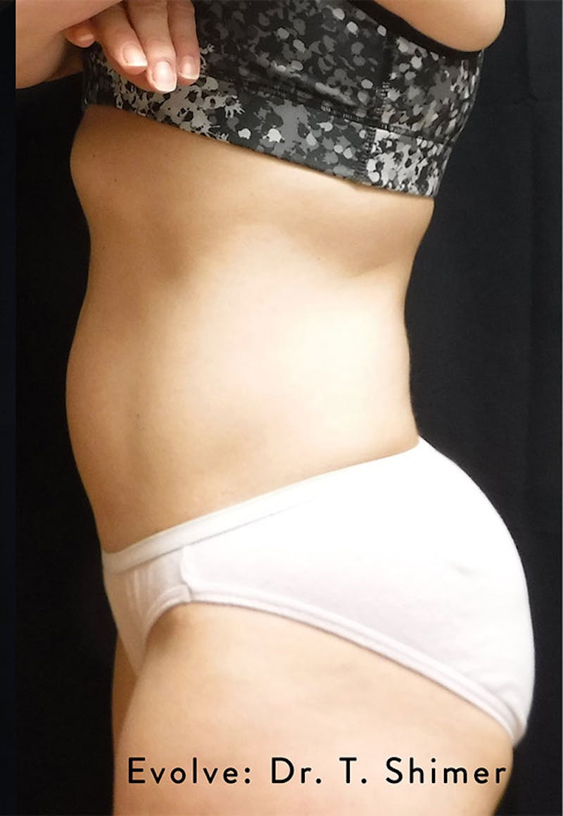 Evolve by InMode Before & After Gallery - Patient 347805 - Image 2