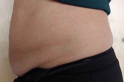 Evolve by InMode Before & After Gallery - Patient 242693 - Image 1