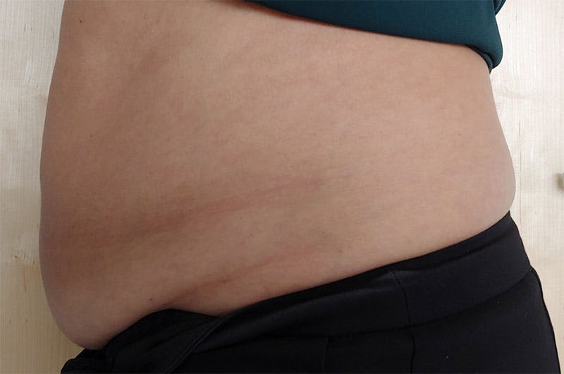 Evolve by InMode Before & After Gallery - Patient 242693 - Image 1