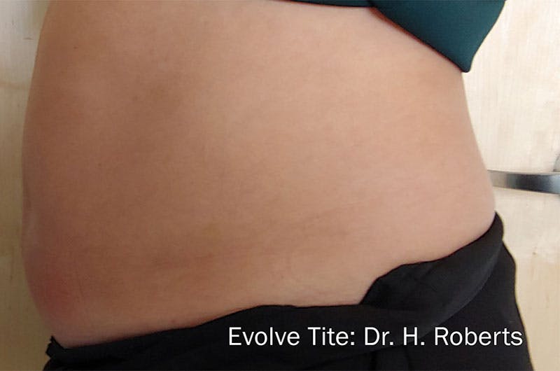 Evolve by InMode Before & After Gallery - Patient 242693 - Image 2