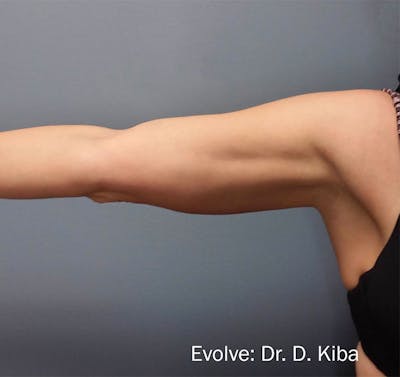Evolve by InMode Before & After Gallery - Patient 490906 - Image 2