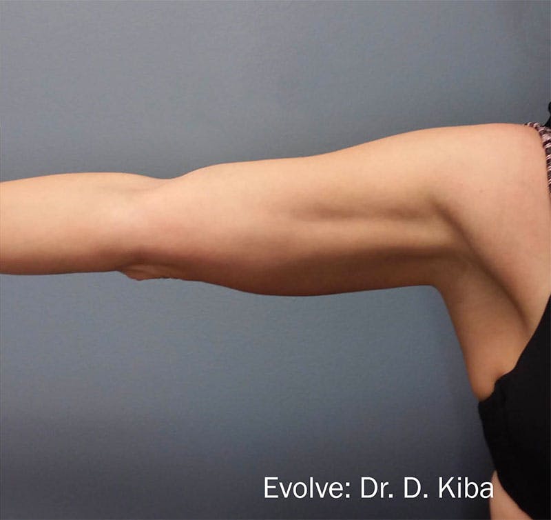 Evolve by InMode Before & After Gallery - Patient 490906 - Image 2