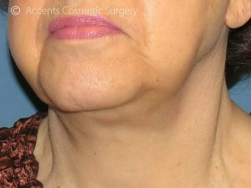 Exilis Face And Neck Before & After Gallery - Patient 284979 - Image 1