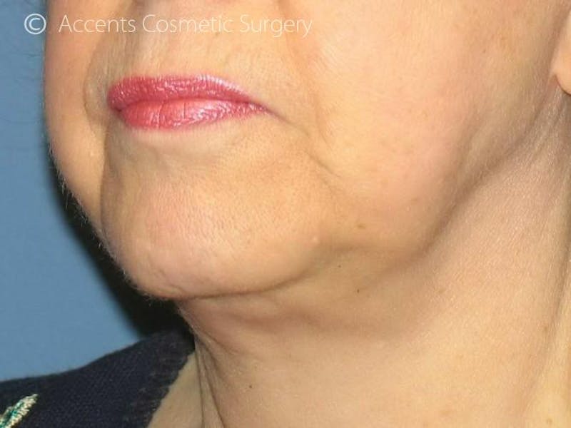 Exilis Face And Neck Before & After Gallery - Patient 284979 - Image 2