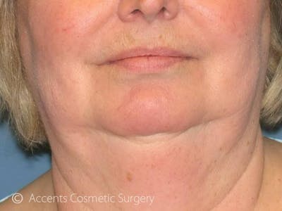 Exilis Face And Neck Before & After Gallery - Patient 180852 - Image 1