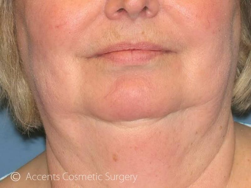 Exilis Face And Neck Before & After Gallery - Patient 180852 - Image 1