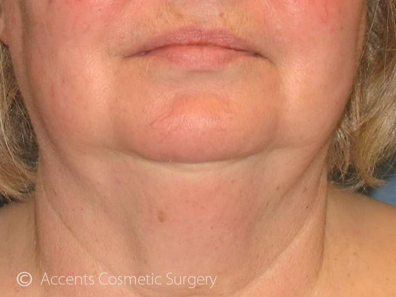Exilis Face And Neck Before & After Gallery - Patient 180852 - Image 2
