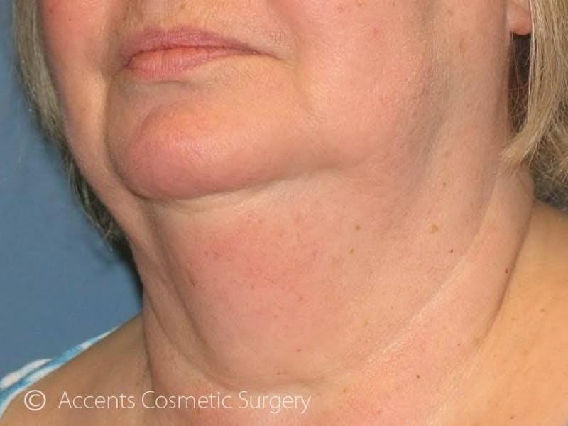 Exilis Face And Neck Before & After Gallery - Patient 180852 - Image 3