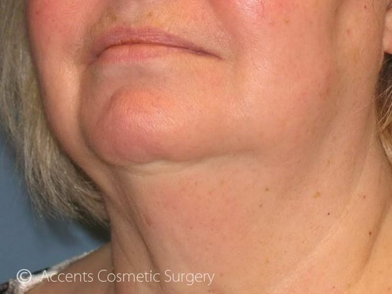 Exilis Face And Neck Before & After Gallery - Patient 180852 - Image 4
