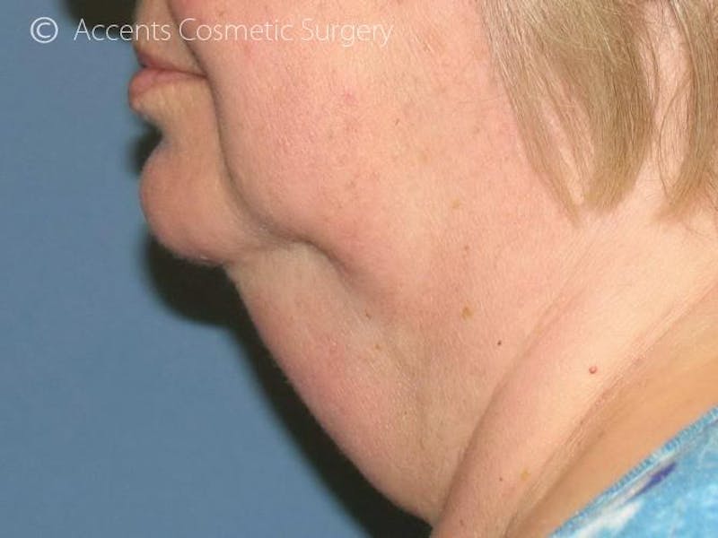 Exilis Face And Neck Before & After Gallery - Patient 180852 - Image 5