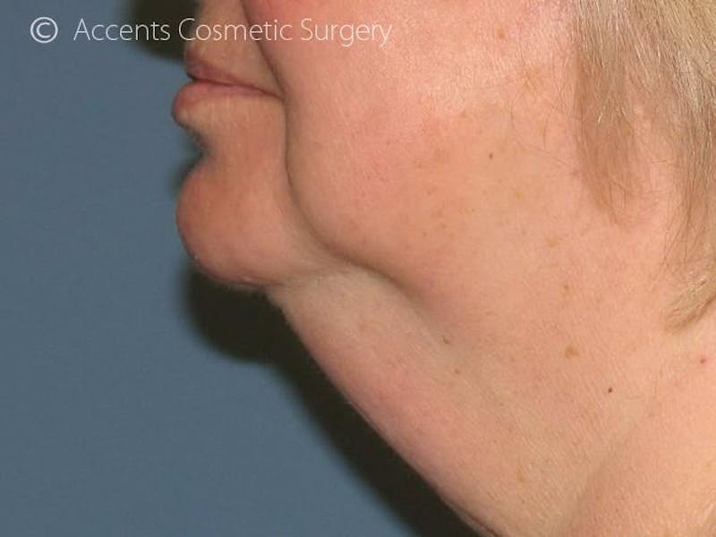 Exilis Face And Neck Before & After Gallery - Patient 180852 - Image 6