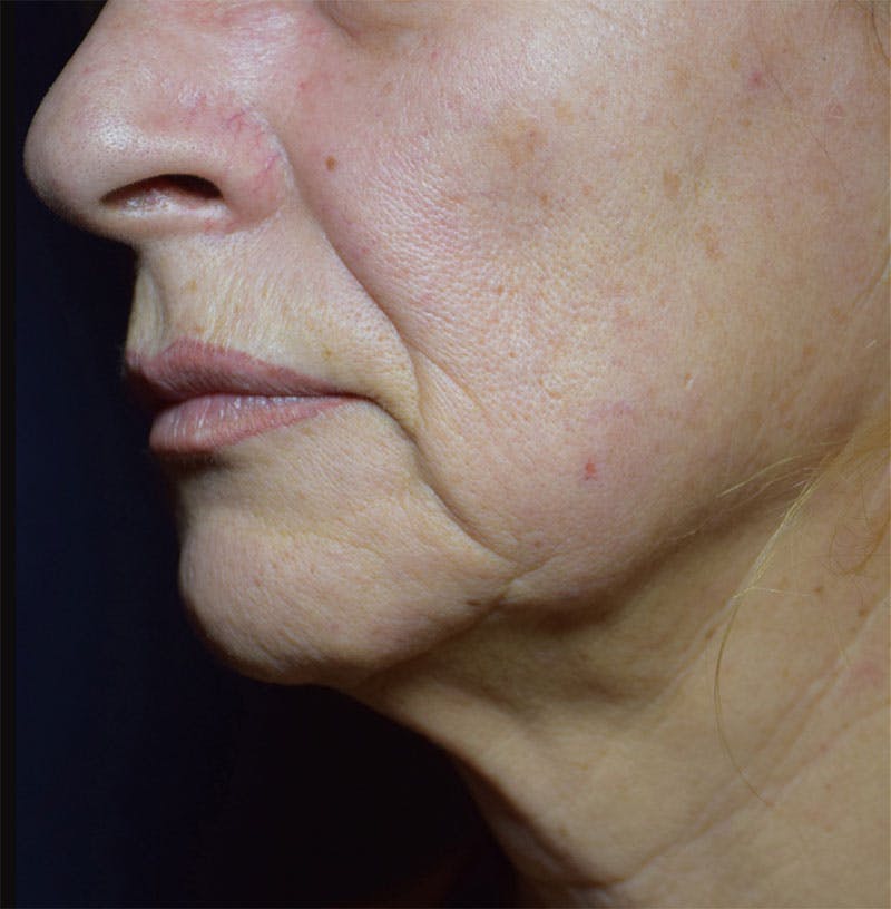 FaceTite by InMode Before & After Gallery - Patient 122682 - Image 1