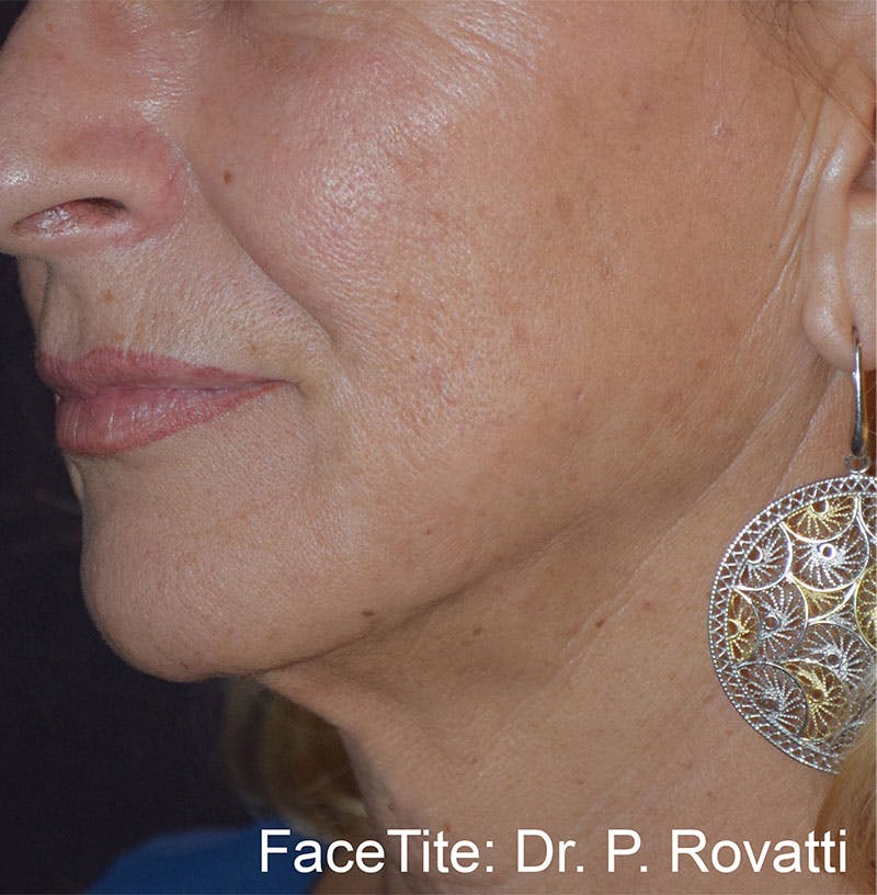 FaceTite by InMode Before & After Gallery - Patient 122682 - Image 2
