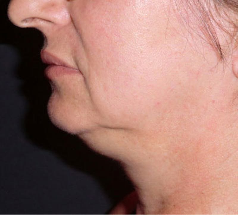FaceTite by InMode Before & After Gallery - Patient 767434 - Image 1
