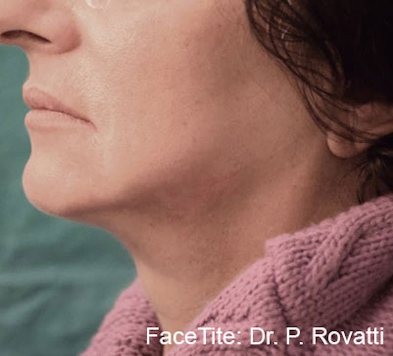 FaceTite by InMode Before & After Gallery - Patient 767434 - Image 2