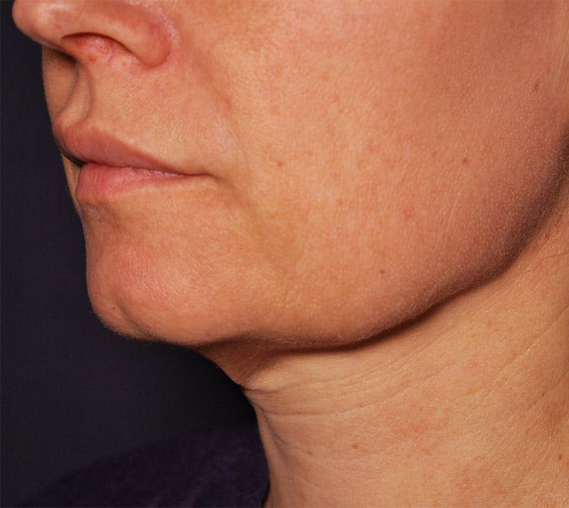 FaceTite by InMode Before & After Gallery - Patient 173360 - Image 1