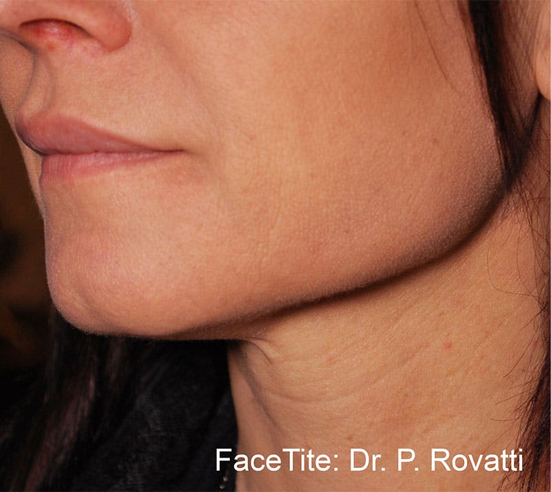 FaceTite by InMode Before & After Gallery - Patient 173360 - Image 2