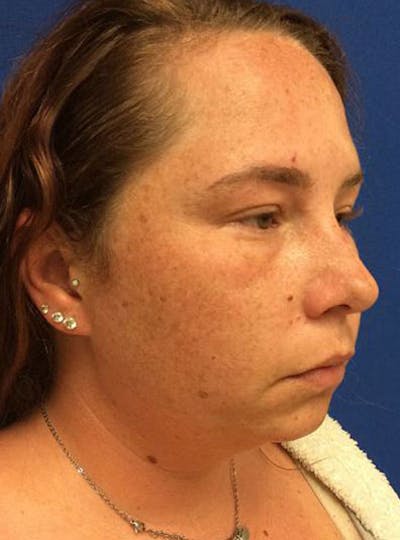 FaceTite by InMode Before & After Gallery - Patient 484060 - Image 1