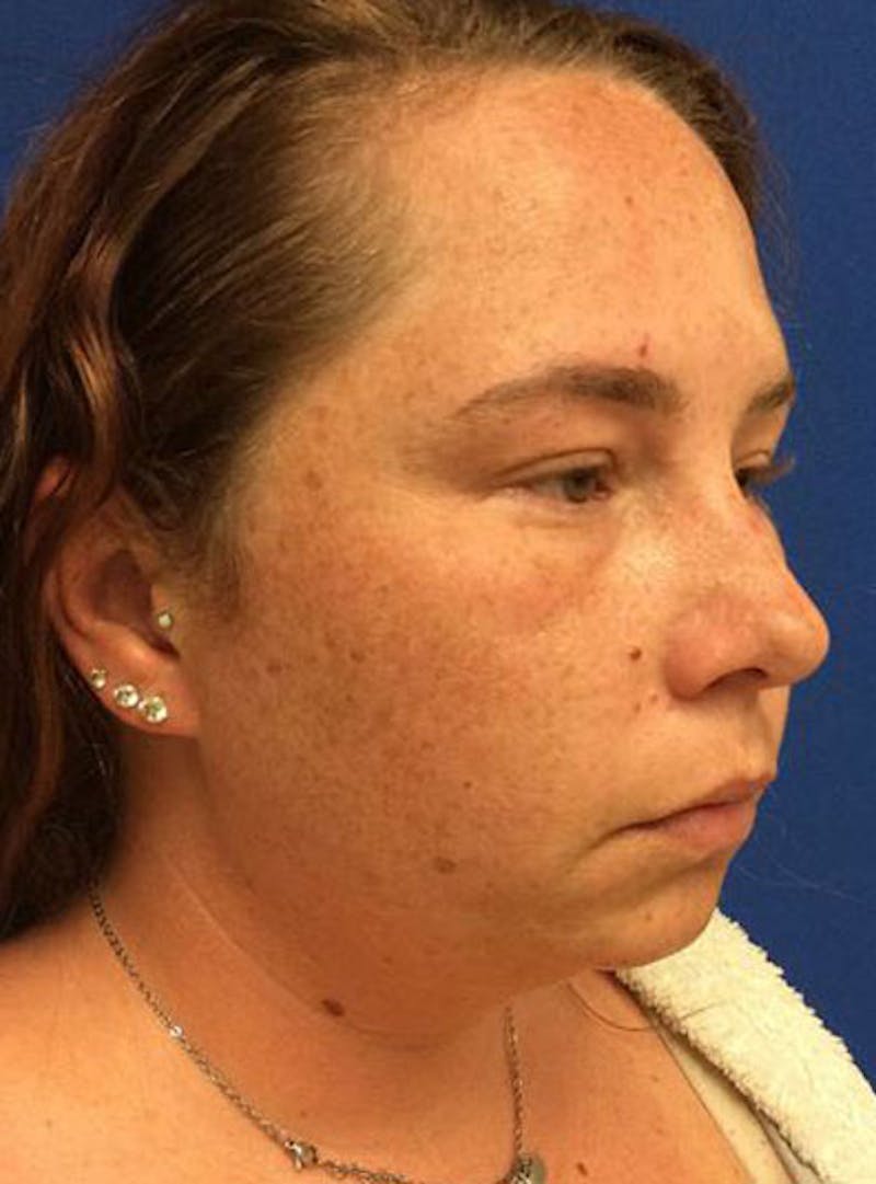 Morpheus8 Before & After Gallery - Patient 185644 - Image 1