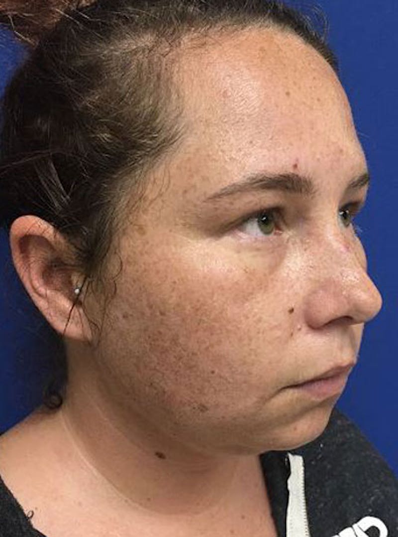 Morpheus8 Before & After Gallery - Patient 185644 - Image 2